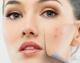 Come eliminare l’acne velocemente