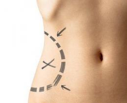 Liposuzione lampo, l'ultima moda delle star