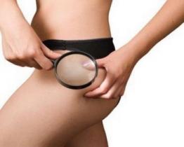 10 cose che dovete sapere sulla cellulite
