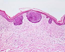 Epidemia di cancro della pelle