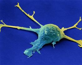 Il cancro vaginale, una malattia rara ma pericolosa